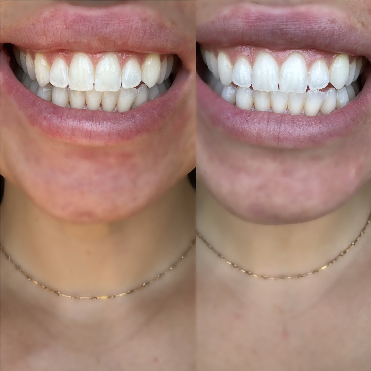 Teeth Whitening Strips