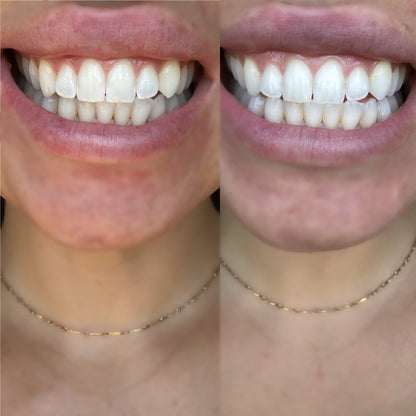 Teeth Whitening Strips
